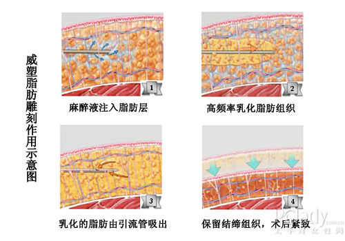 治疗过程:   1,麻醉液注入脂肪层   2,威塑探针以36,000赫兹频率