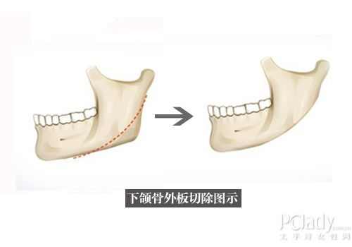 可同時採用下頜骨外板切除術和長弧形截骨術,另外可結合隆下頦或頦